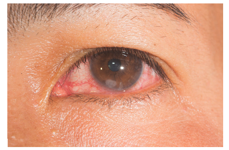 Dormir com lentes de contato pode causar infecção