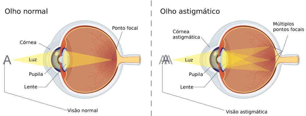 Para que serve a lente de contato tórica