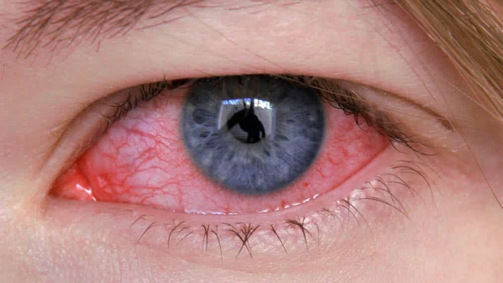infecção nos olhos
