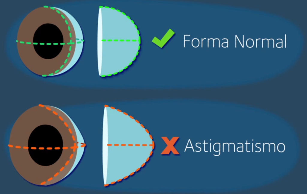 O que é astigmatismo?