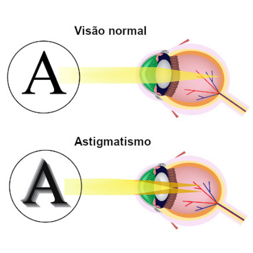 astigmatismo