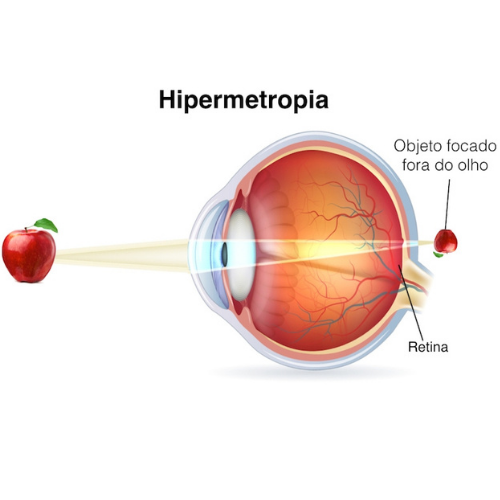 hipermetropia