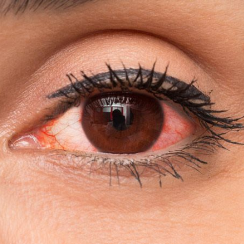 Vermelhidão nos olhos