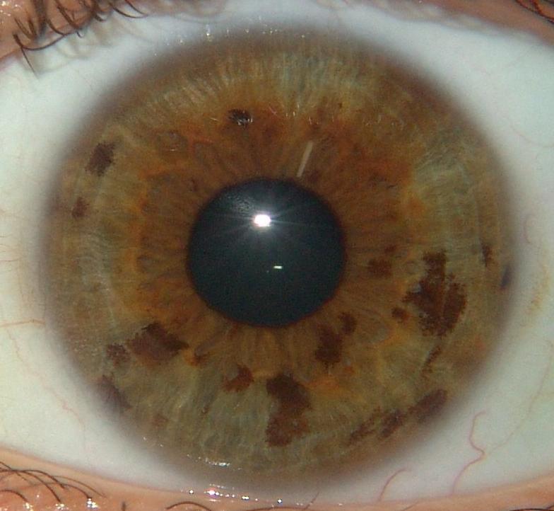 Sintomas de câncer nos olhos