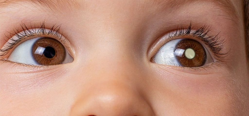 Principais tipos de câncer nos olhos