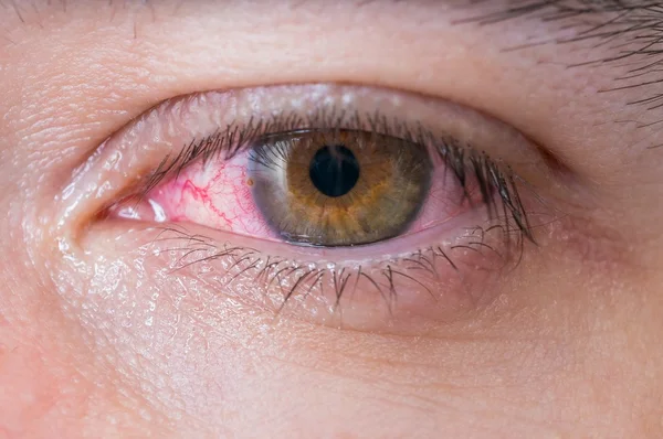 Consequências de coçar os olhos com frequência