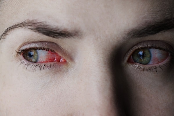 Síndrome dos olhos secos