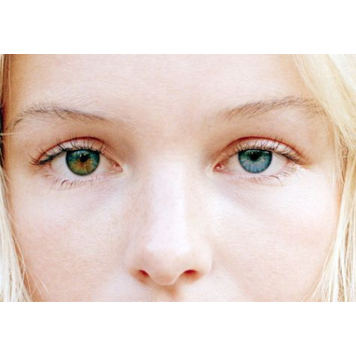 Heterocromia, causa e tipos