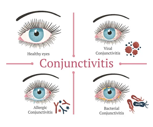 Conjuntivite