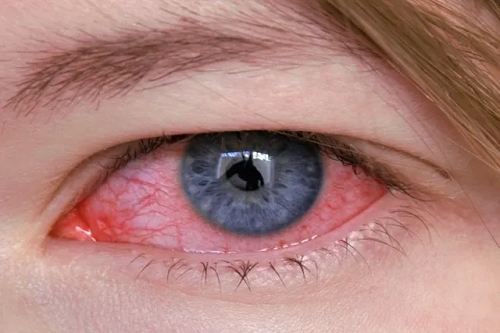 Trauma ocular