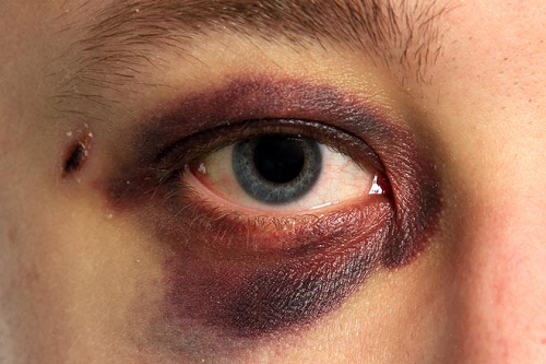 Trauma ocular