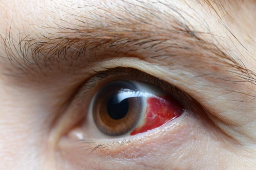 Trauma ocular
