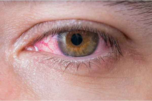 alergias oculares