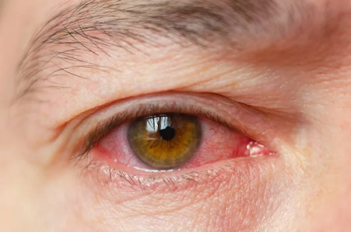 Irritação nos olhos após retirar as lentes de contato, o que fazer?