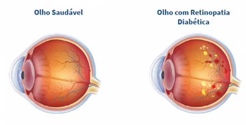 retinopatia diabética