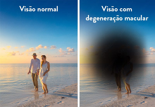 7 doenças mais comuns na retina
