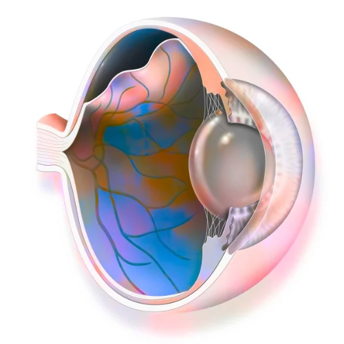 Descolamento de retina o que é e quais os tratamentos