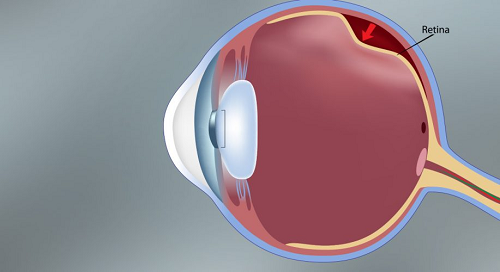 7 doenças mais comuns na retina
